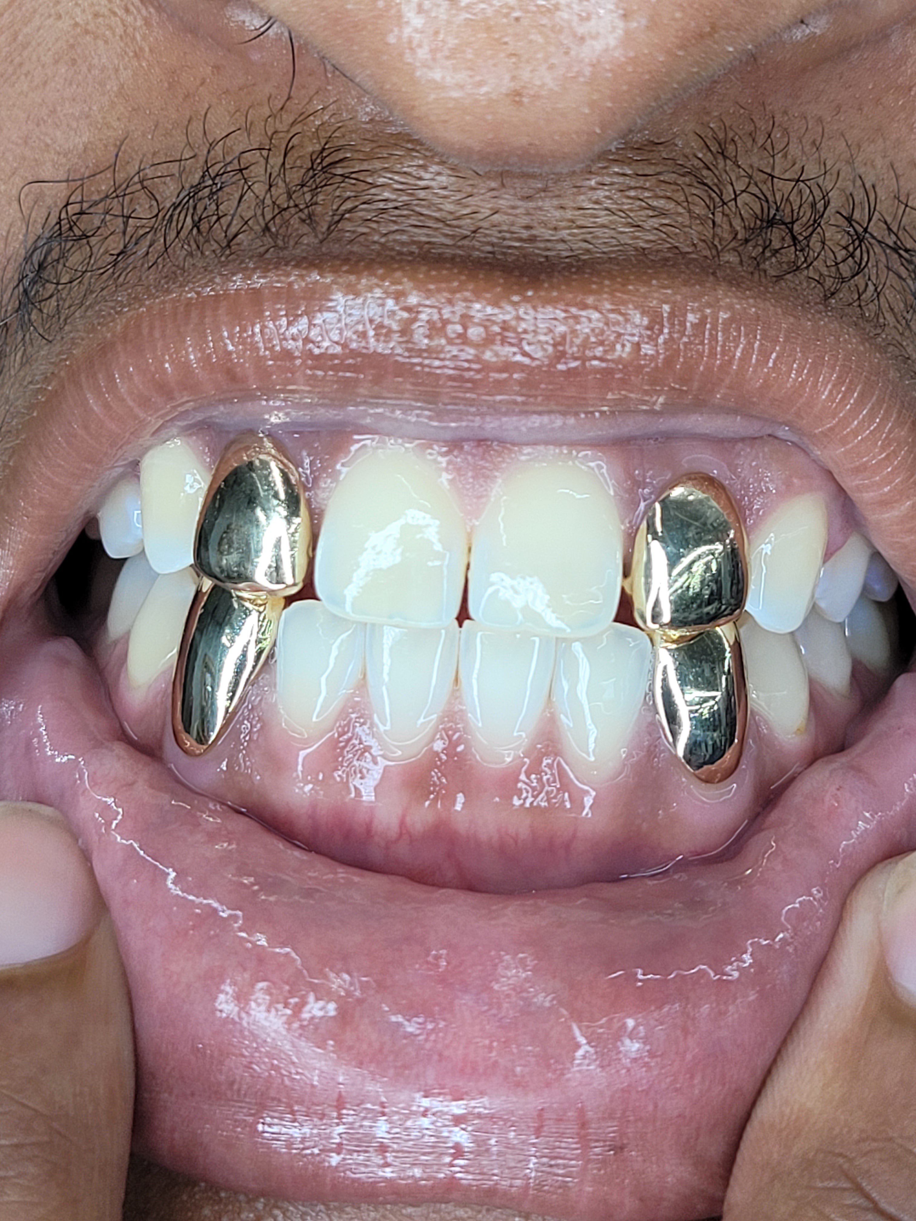 Bottom Tooth 2 Top Solids 2 Bottom Solids (4 Teeth Total) – New Orleans Tooth Gems ...