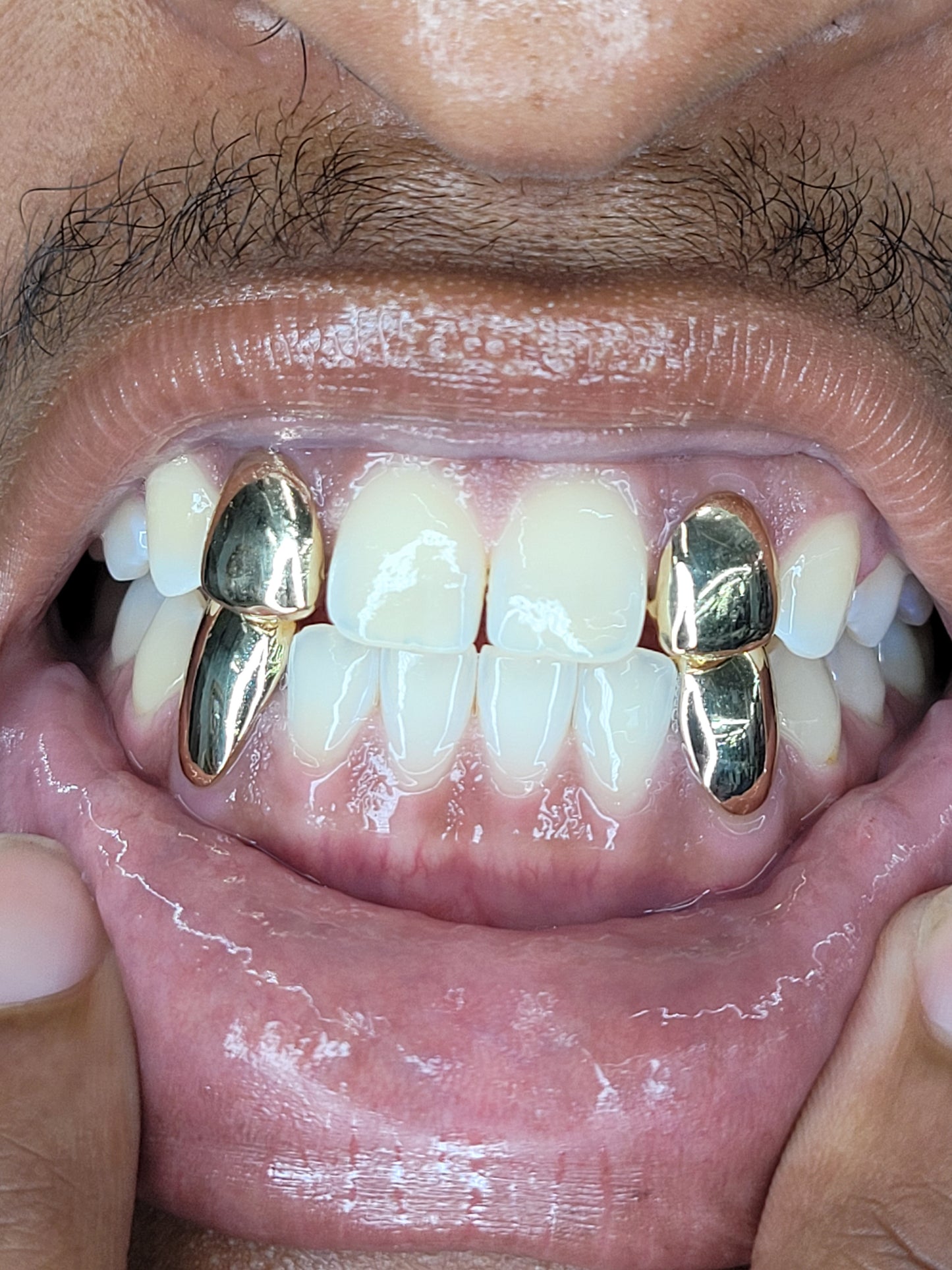 2 Top Solids 2 Bottom Solids (4 Teeth Total)