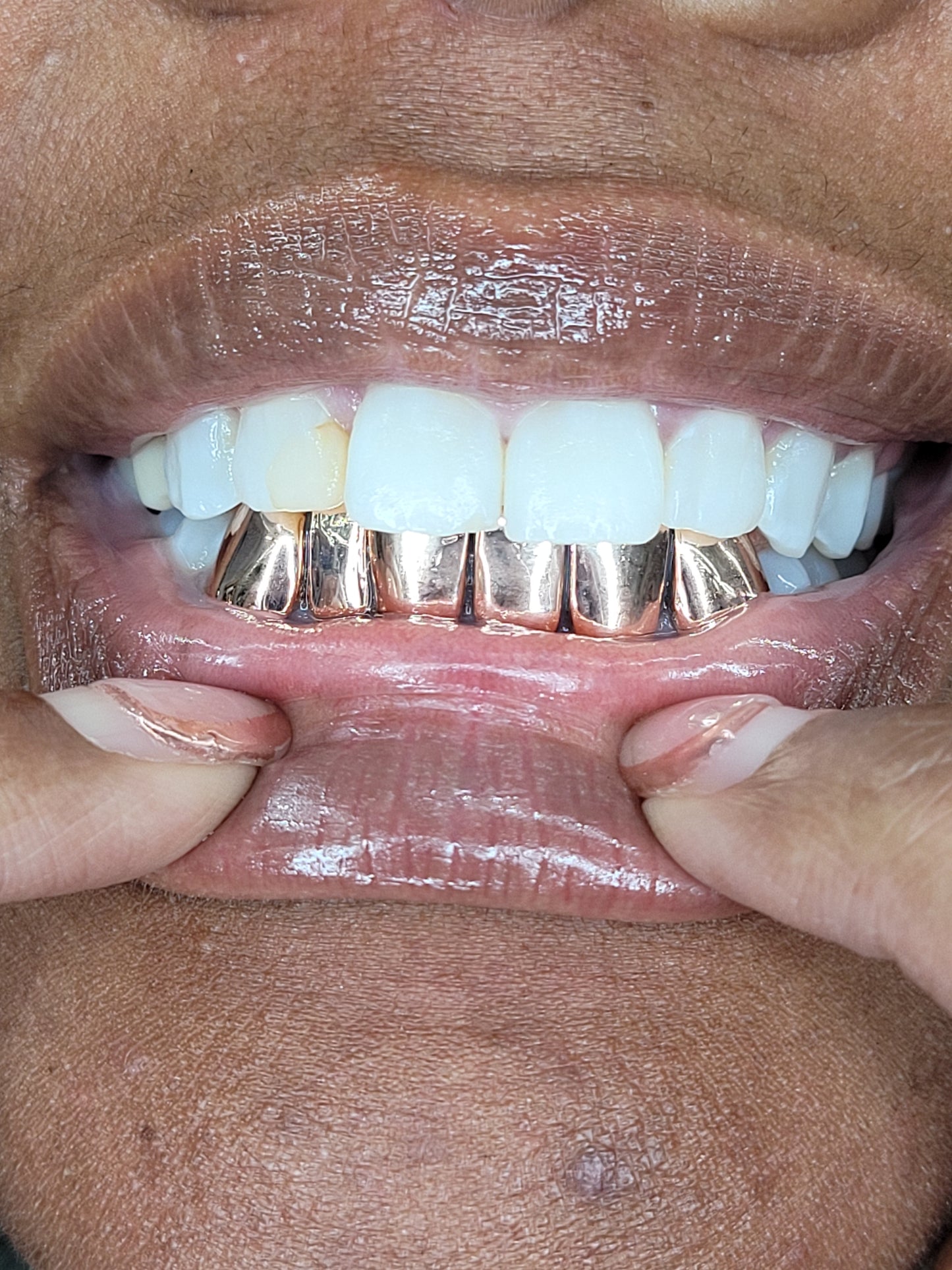 Solid 6 Piece Grillz (Connected)
